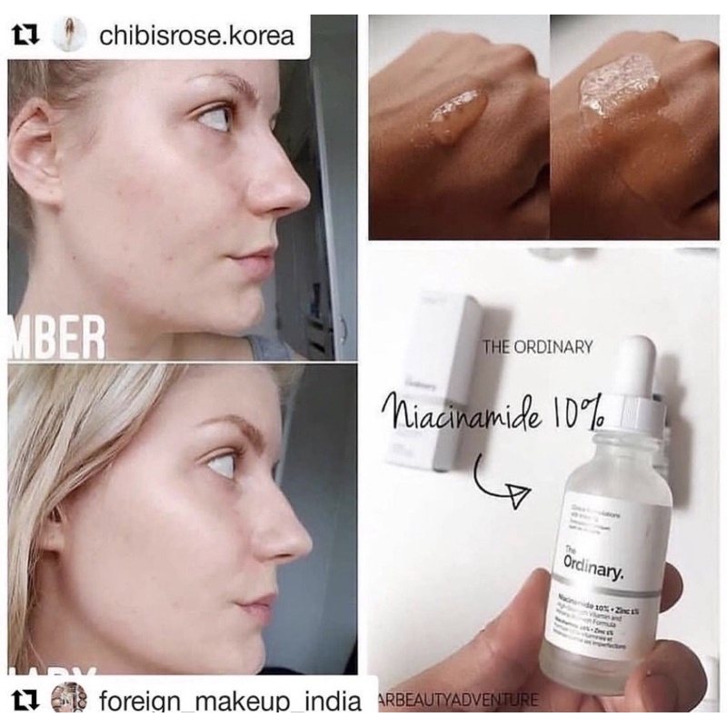 Tinh chất The Ordinary Niacinamide 10% + Zinc 1%