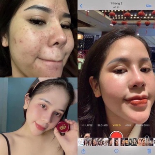 Cao sâm mụn đỏ hàng chính hãng
