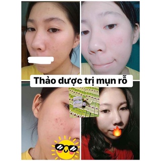 ( 2 lọ )Thảo Dược Sạch Mụn Thâm Rỗ MT (50ml)
