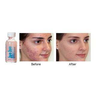 Chấm mụn Bye Bye Blemish Drying Lotion