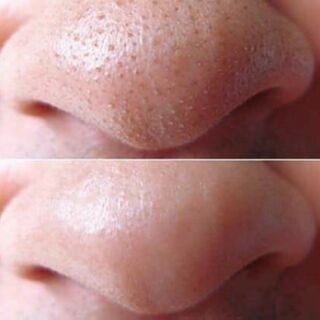Mask gel titione