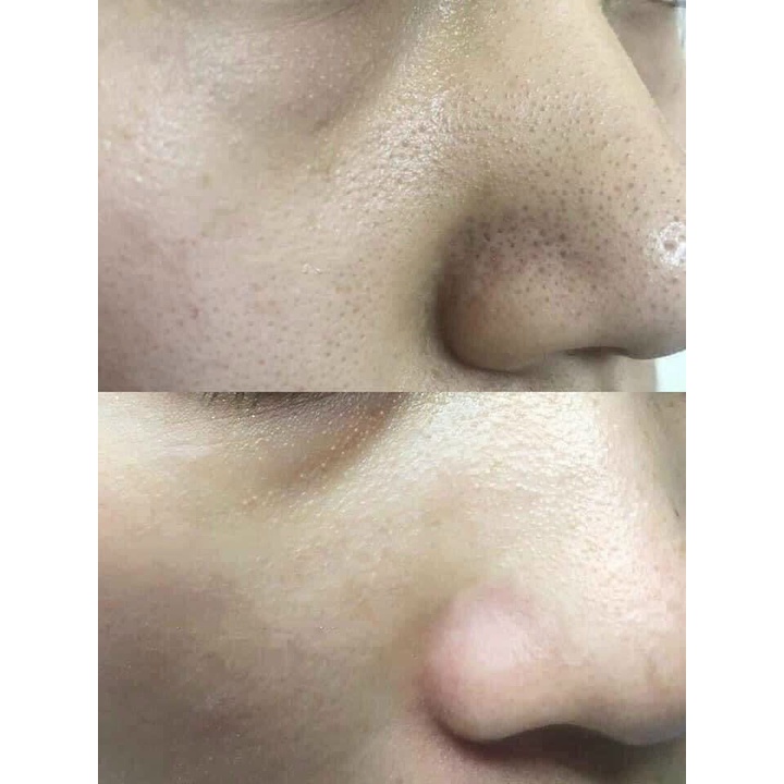 [CHIẾT]  Ủ MỤN ĐẦU ĐEN Super Extra9  Medipeel | BigBuy360 - bigbuy360.vn