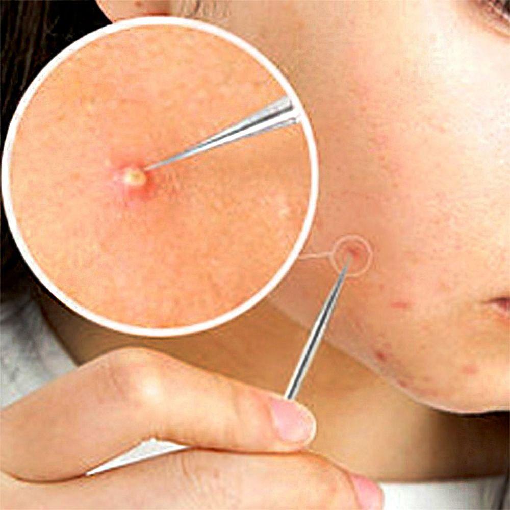 Bộ 3 Dụng Cụ Loại Bỏ Mụn Đầu Đen Chăm Sóc Da Chuyên Nghiệp