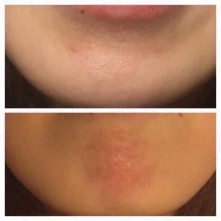 Kem lành thâm sẹo mụn Smoothe