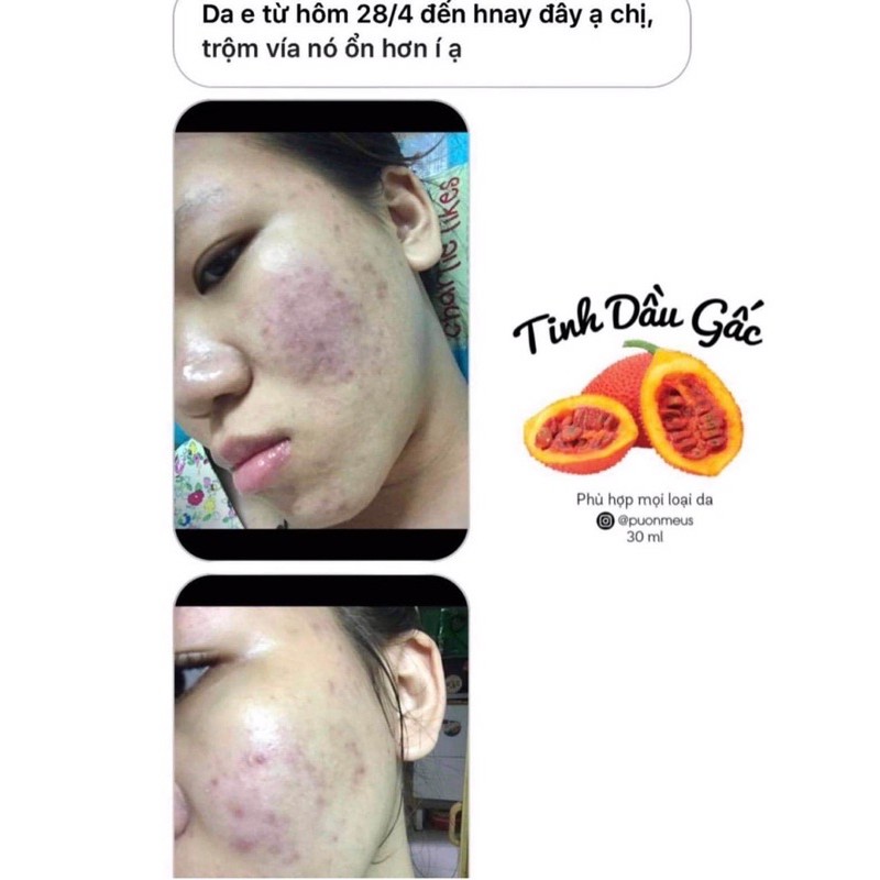 Tinh Dầu Gấc Tái Tạo Da | BigBuy360 - bigbuy360.vn