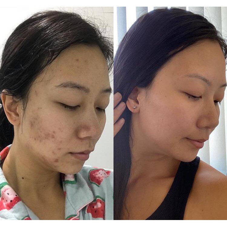 Serum cho da mụn Bielenda Medica Anti Acne loại bỏ mụn tái tạo da