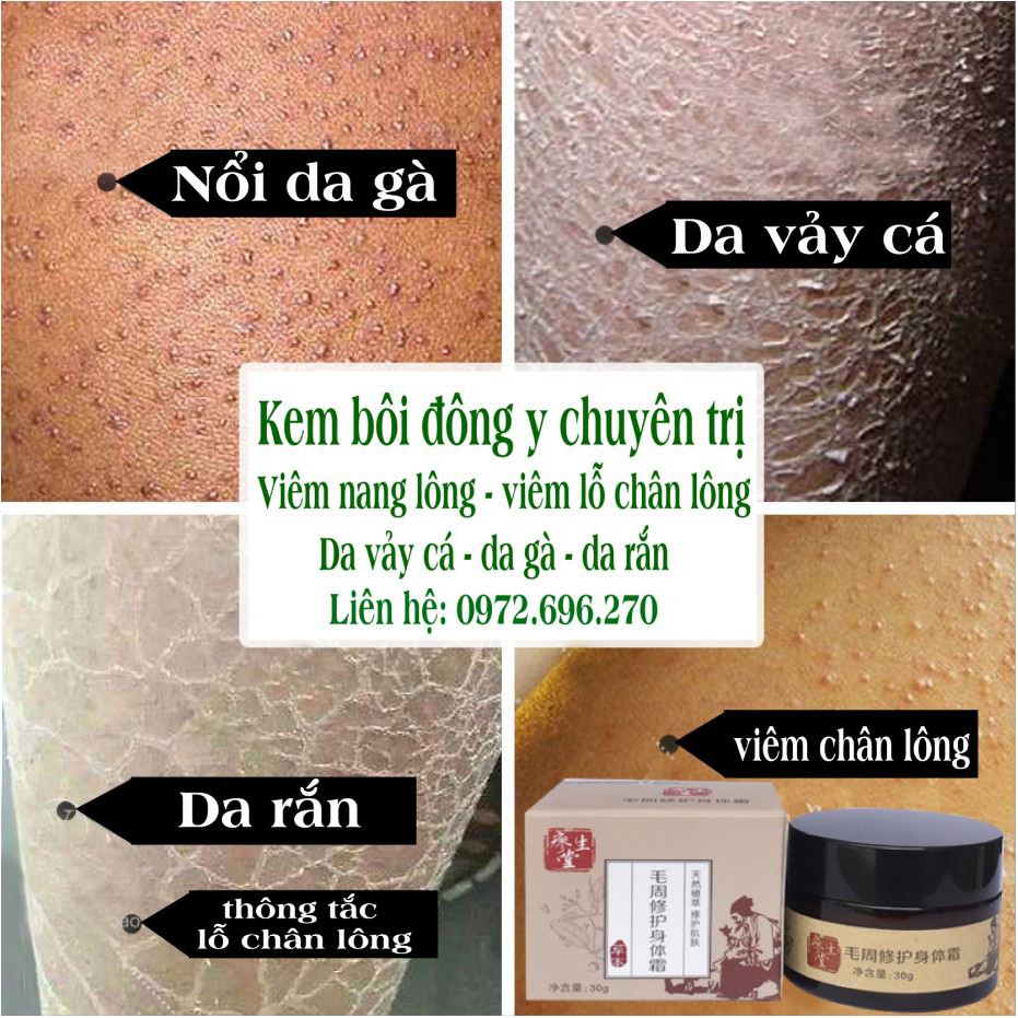 Kem bôi viêm nang lông - viêm lỗ chân lông [ Cực hiệu quả ] | BigBuy360 - bigbuy360.vn