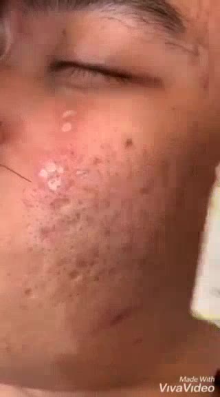 Peel TCA Làm Đầy Sẹo Rỗ Sẹo Lõm - Tặng 2 Chai Tế Bào Gốc |  TRICHLOROACETIC ACID | BigBuy360 - bigbuy360.vn