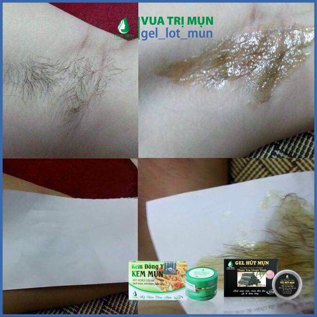 Combo triệt lông vĩnh viễn Wax + Mỡ Trăn. Tẩy lông handmade an toàn tặng kèm bộ dụng cụ wax , cam kết hàng chính hãng