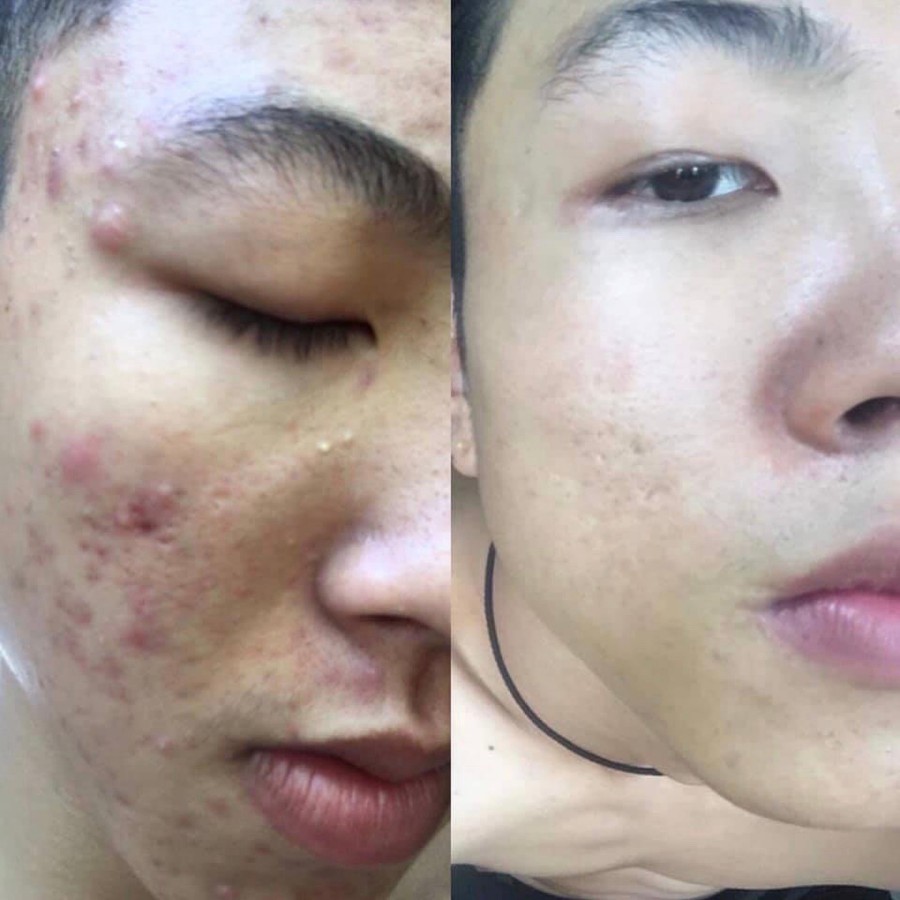 Tạm biệt da thô sần sùi chỉ với kem 3Day colagen