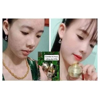 [ Kèm quà] Combo chuyên mụn Huỳnh Đỗ, sạch mụn hết thâm