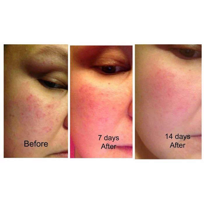 Tinh chất ốc sên giảm mụn, tái tạo da Images – SVN