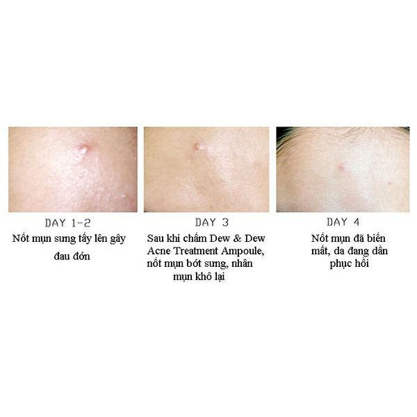 Serum Dew&Dew Acne Treatment Ampoule 30ml - 24k gold whiterning Serum Glactomy 30ml - Tất cả các dòng