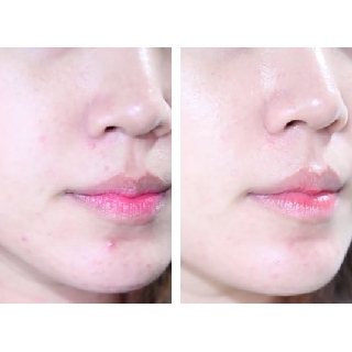TINH DẦU TRÀM TRÀ #CHẤM_MỤN - TEA TREE OIL - CHẤM MỤN HIỆU QUẢ