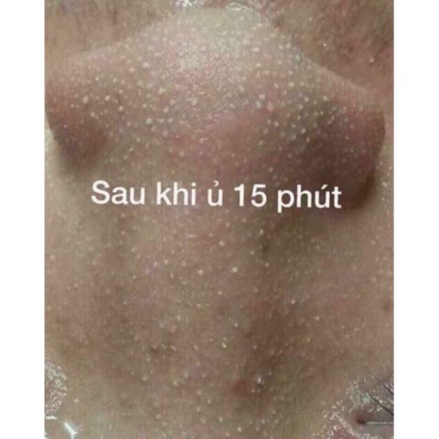 [SPA HN] Ủ Mụn YOUNGERC Thần Thánh