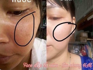 Face Nám HM Store