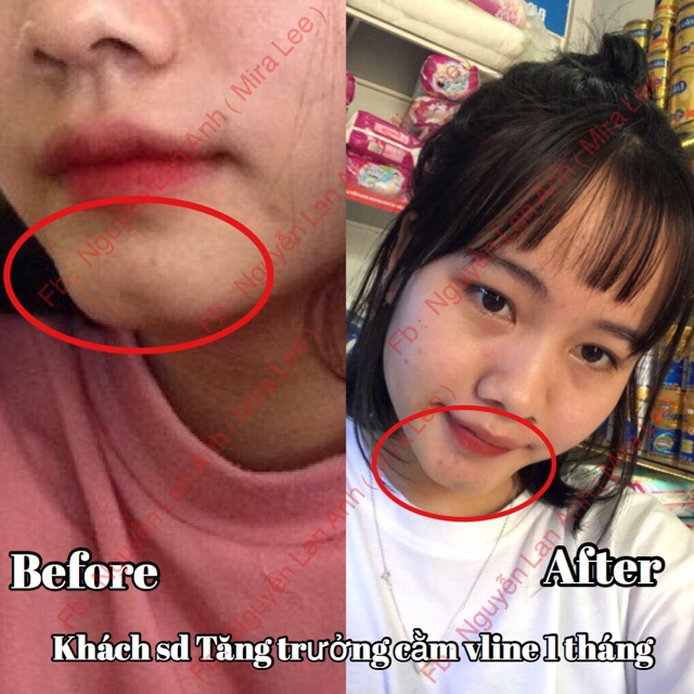 Tinh Chất Tăng Trưởng Thon Dài Cằm Vline