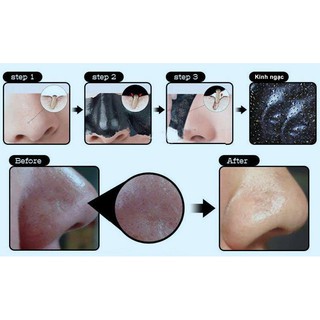 Gel Hút Mụn Cám Và Mụn Đầu Đen Chiết Xuất Than Tre Hoạt PV Bình 50g