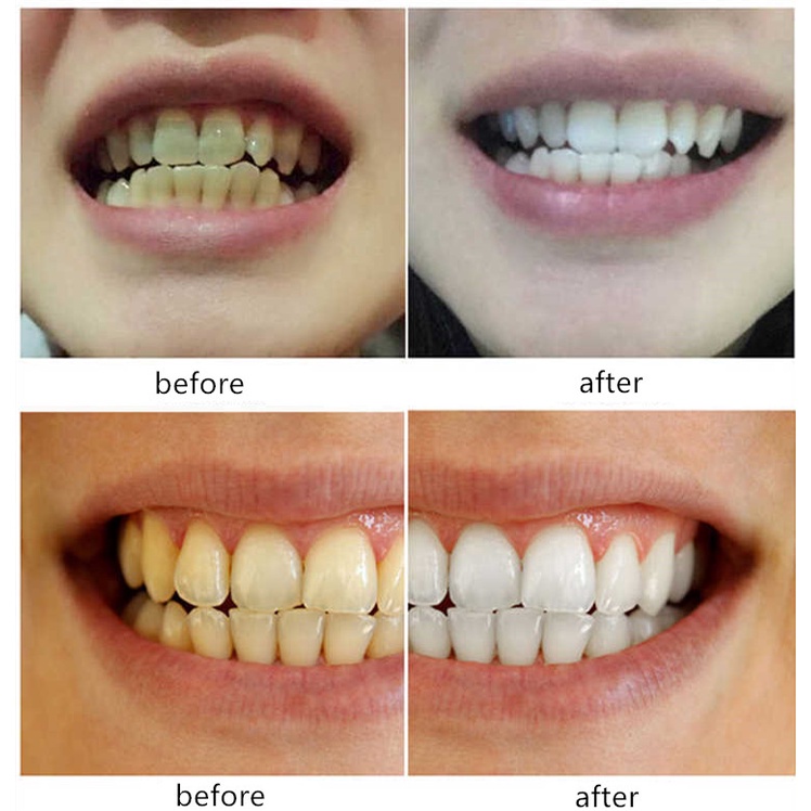 1 Ống Nước Vệ Sinh Răng Miệng 10ml