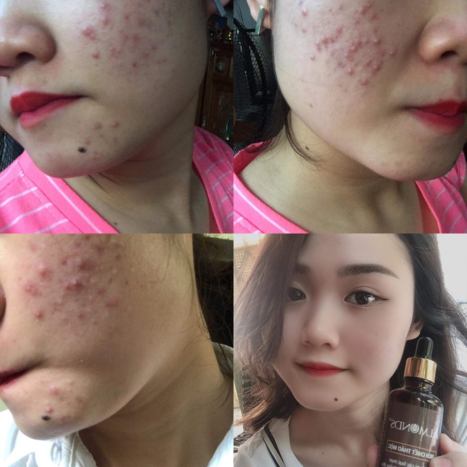 Dịch chiết ALMONDS dành cho da mụn, sẹo rỗ 50ml
