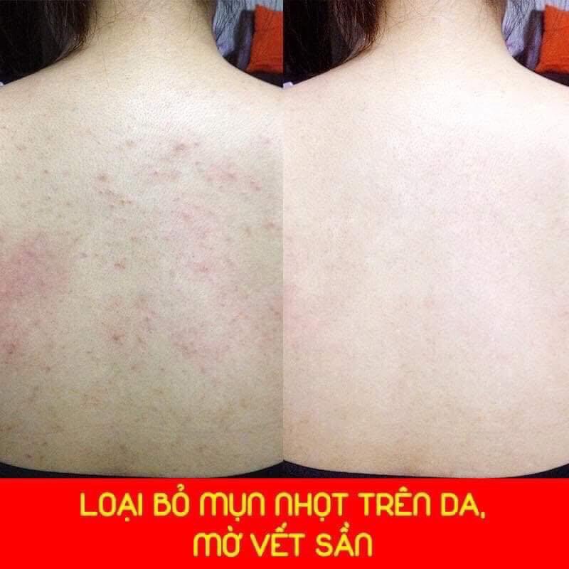 Dứt điểm mụn lưng - giảm nang lông 💓𝐅𝐑𝐄𝐄 𝐒𝐇𝐈𝐏💓 Tẩy Tế Bào Da Chết Body - Muối Tắm Tinh Chất Sữa Non Lasenta