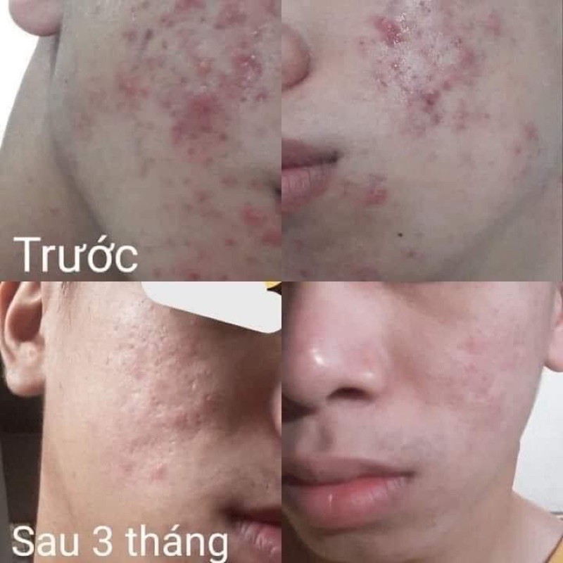 [VIBA] Xịt khoáng tươi nguyên chất Formen 100ml Khoáng Tươi ViBa dưỡng ấm, bù khoáng, khóa lớp trang điểm, kiềm dầu | BigBuy360 - bigbuy360.vn