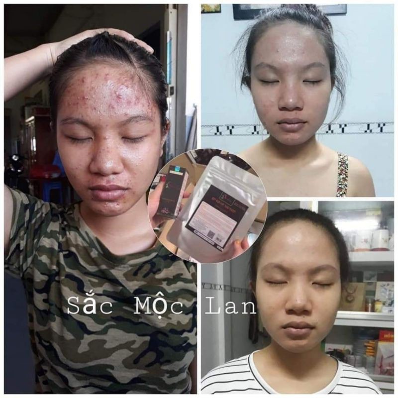 Sắc Mộc Lan Tái Tạo Da xóa tan Mụn, Nám, Thâm, Tàn nhang Hiệu quả | BigBuy360 - bigbuy360.vn
