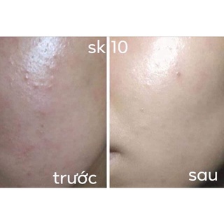 Huyết Thanh Sk10 1 Ống (chấm mụn)