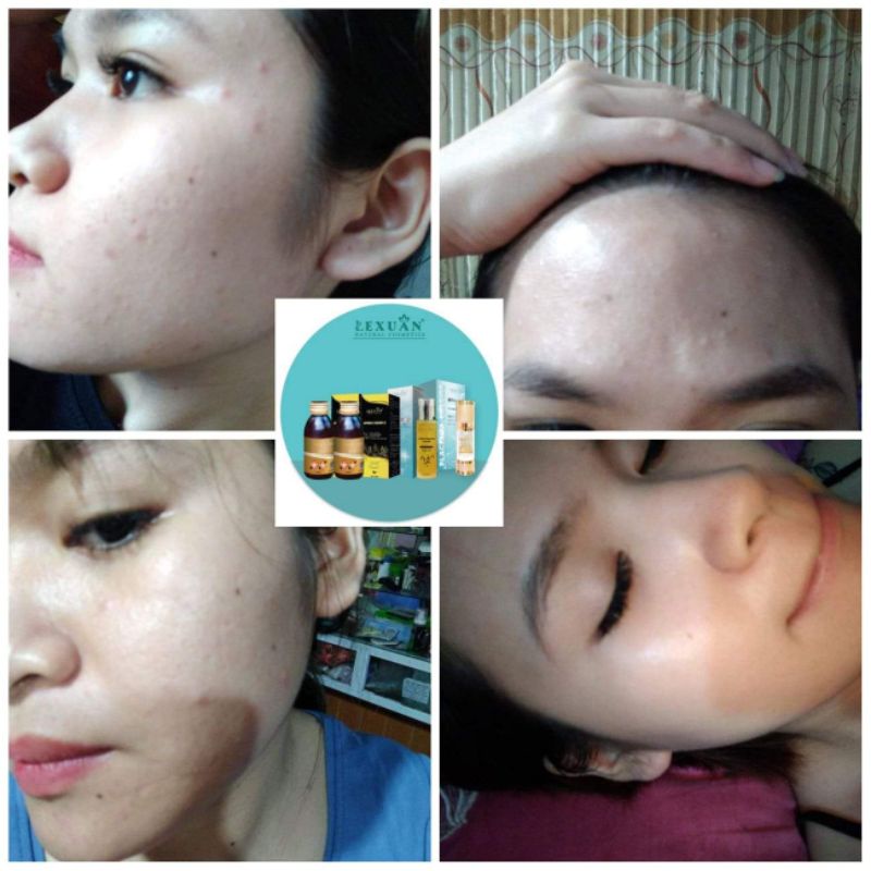 Thảo Dược Đông Y Lê Xuân🍒Trắng Da-Kiềm dầu-Mờ Thâm Nám | BigBuy360 - bigbuy360.vn