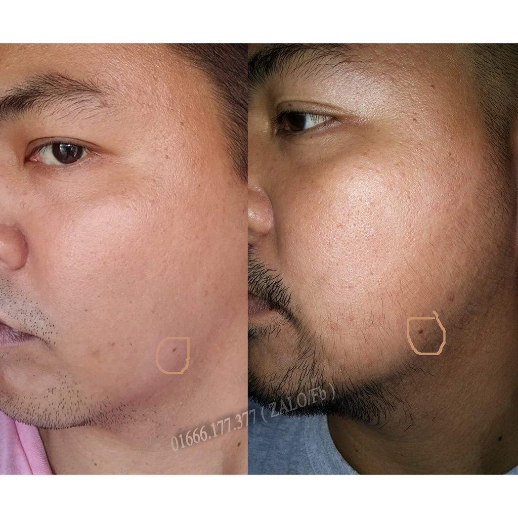 #FREESHIP - Combo Minoxidil 5% Kirkland  và Folic và Biotin - Thuốc mọc râu - Trị Hói