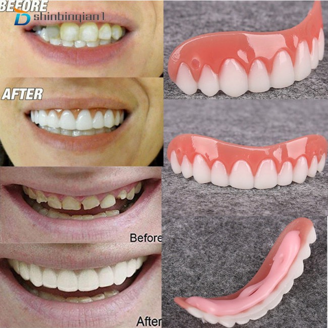 Niềng răng giả hình răng tạo lớp vỏ che khi cười bằng chất liệu silicon