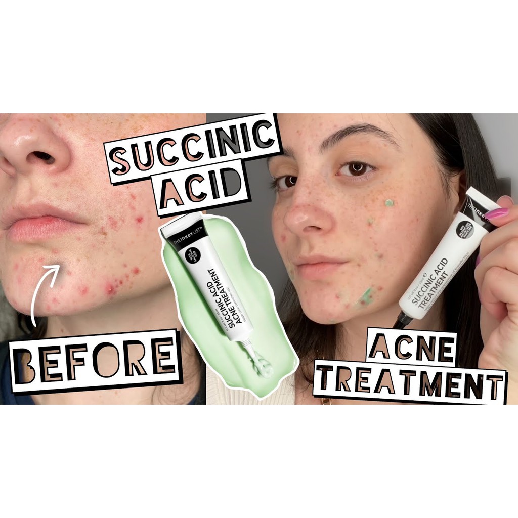 Kem chấm mụn THE INKEY LIST SUCCINIC ACID ACNE TREATMENT