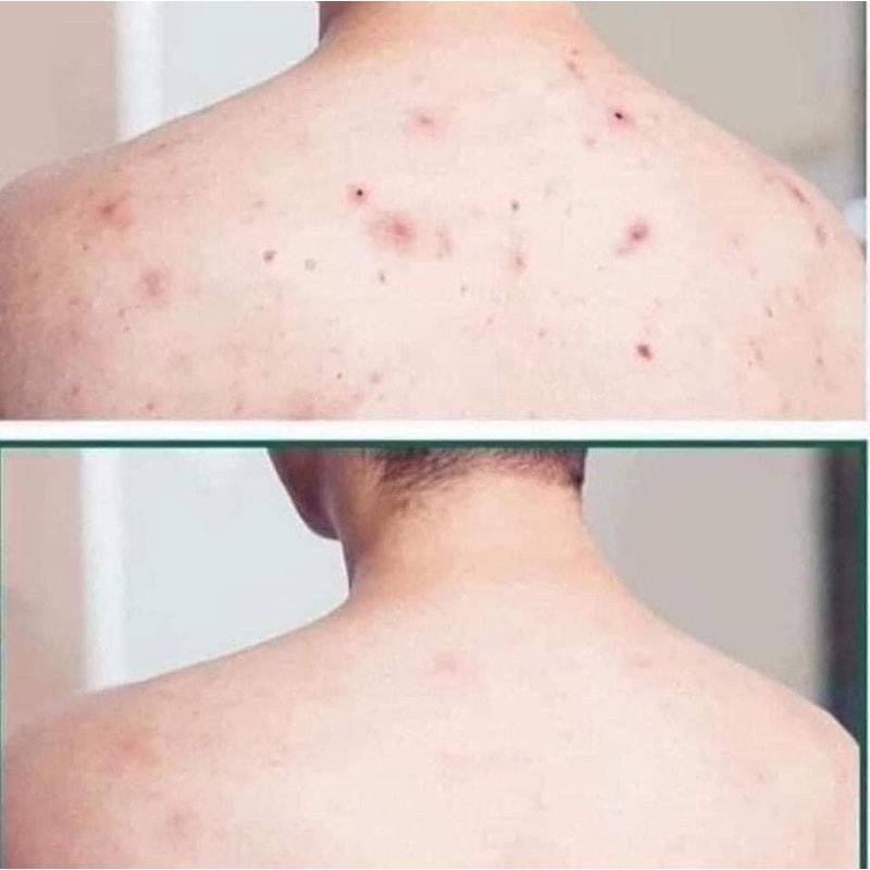 Sữa tắm giảm mụn lưng A-DERMA