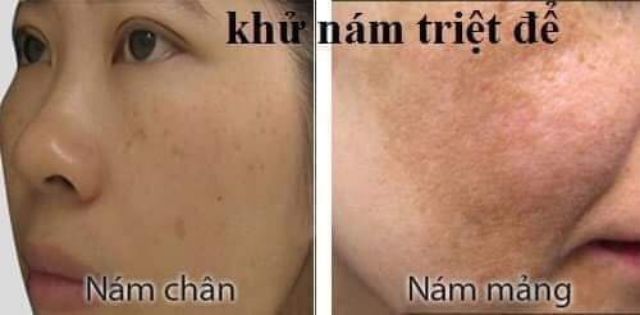 Hút nám thải độc da