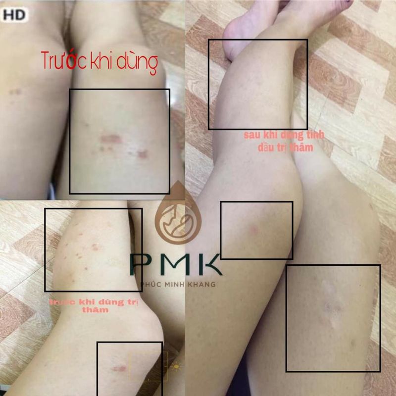 Tinh chất Xóa thâm Minh Khang Xoá mờ thâm sẹo thâm mắt, thâm môi, thâm nách, thâm mụn, thâm sẹo lâu năm