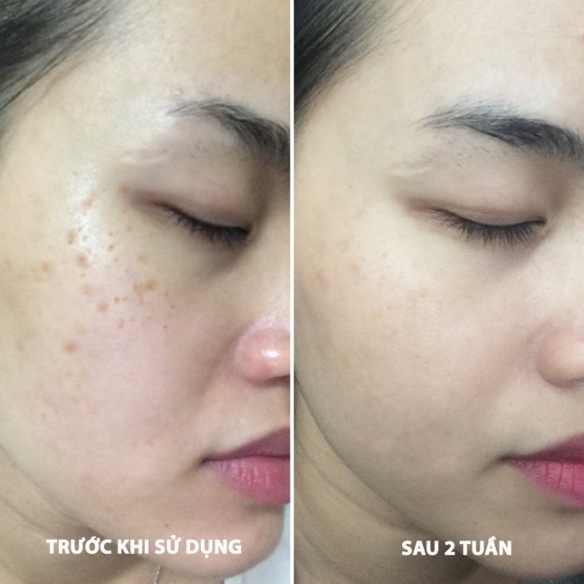 Tinh Chất Giảm Nám Eucerin Ultra White+ Spotless Spot Corrector