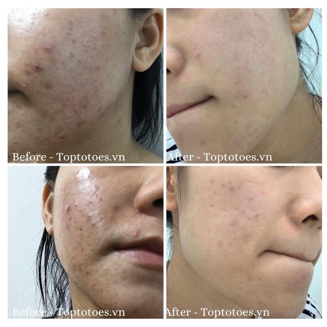 Serum Teana Super Peptides No Problem Intensive Care giảm sưng, đẩy & gom cồi mụn, giảm tiết dầu