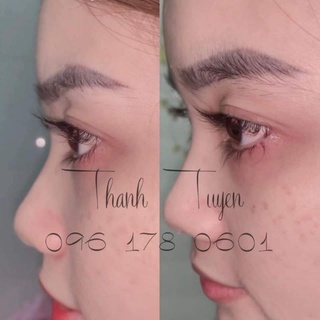 Serum mọc mi
