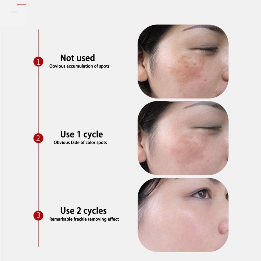 Kem Hỗ trợ giảm tàn nhang Và Đốm Đen Làm Trắng Da 30g