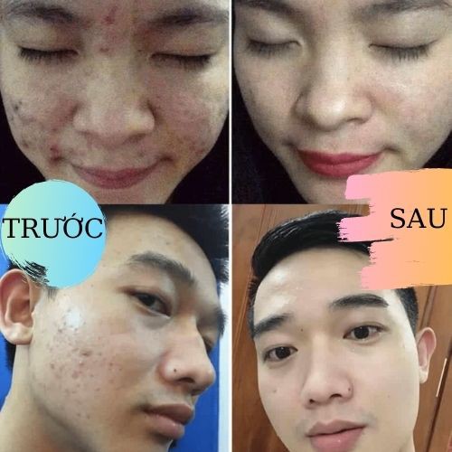 Combo da mụn (bột rửa mặt, chấm mụn thảo mộc) Đông y gia truyền Thông Cát_Làm sạch sâu, chăm sóc da hiệu quả tại nhà