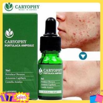 Sỉ-  Serum ngăn ngừa mụn và thâm Caryophy Chính Hãng - Serum Mụn Ngăn Ngừa Mụn Ẩn,Mụn Đầu Đen | BigBuy360 - bigbuy360.vn