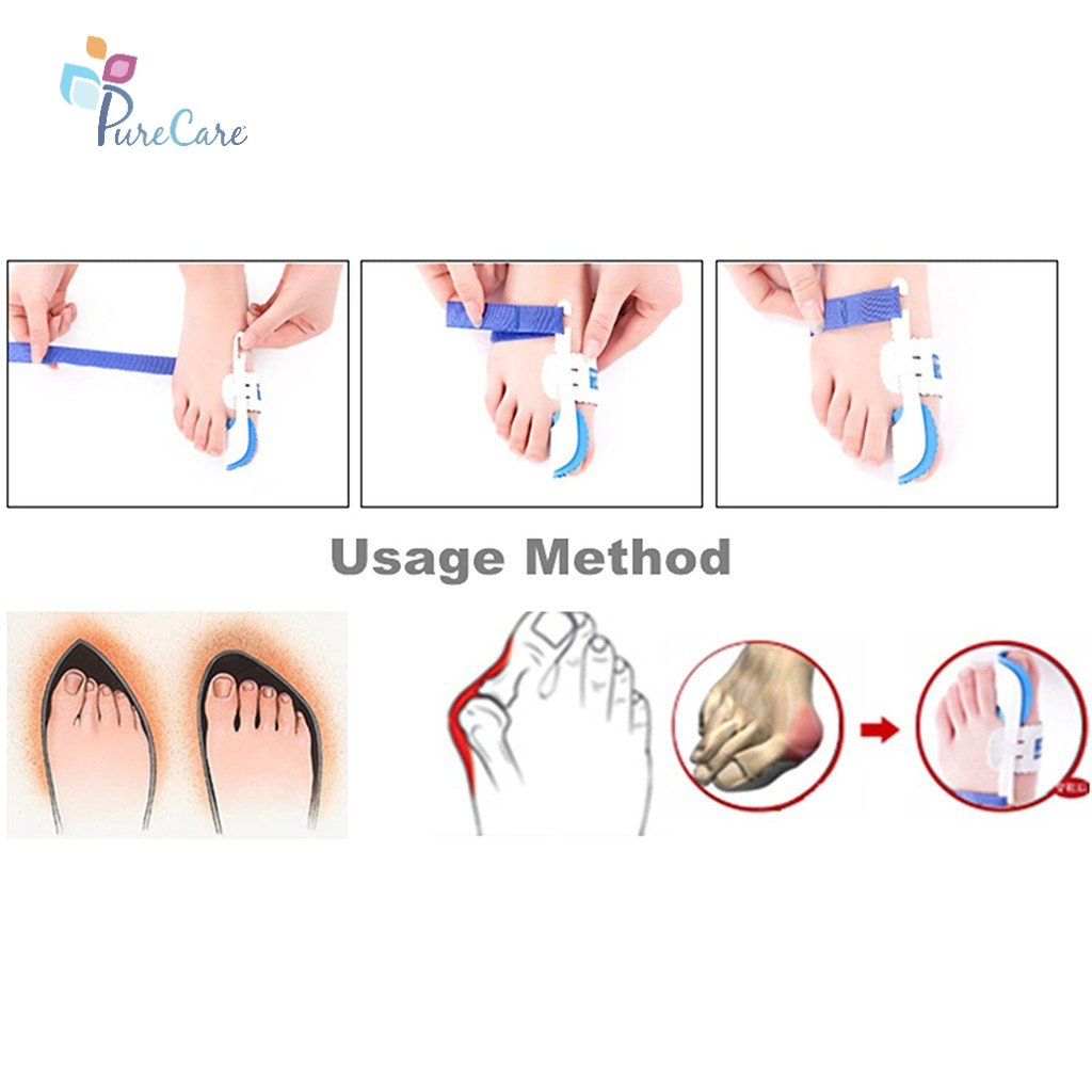 Nẹp duỗi thẳng cho người vẹo ngón chân cái