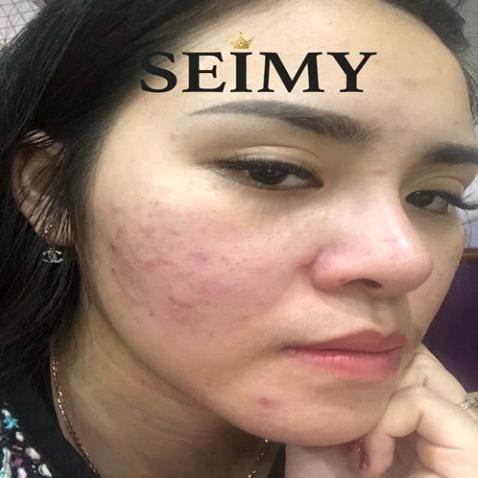 [Chính Hãng] Serum Giảm  Mụn Thâm Rỗ Seimy - Skin 7 Days 10 ml