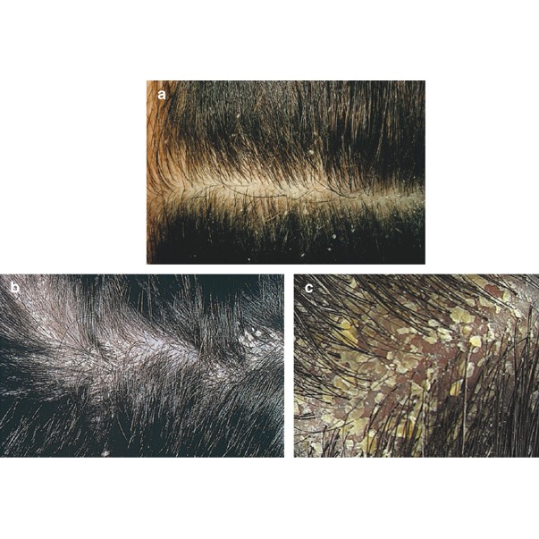 Trị gầu, nấm da đầu, rụng tóc do nấm gây ra đạt hiệu quả cao, an toàn khi sử dụng xuất xứ australia