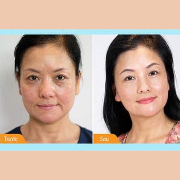 Vitamin e đỏ 400 viên uống đẹp da giảm nám mờ nhăn chống lão hoá