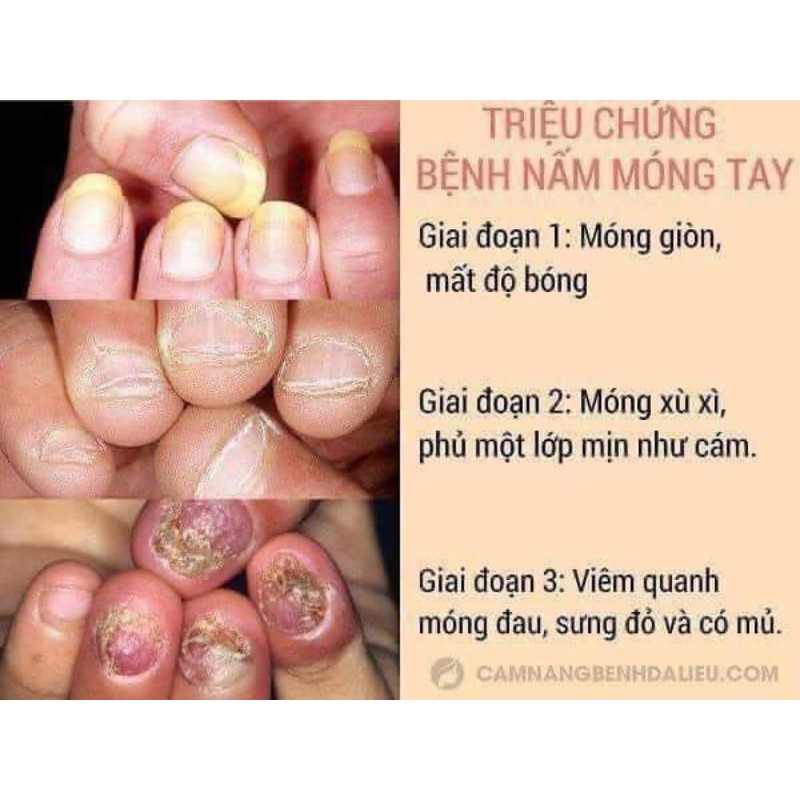 Dưỡng móng hư tổn hiệu quả nhanh