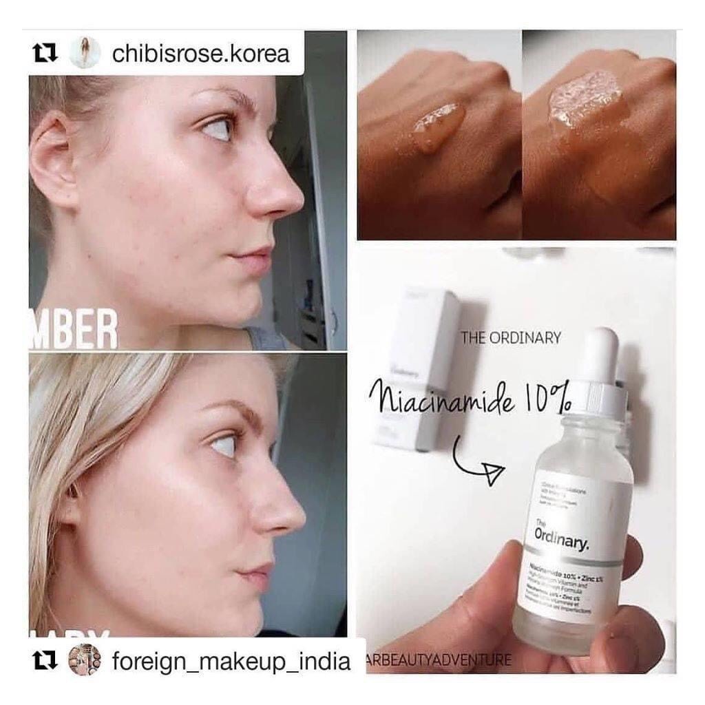 The Ordinary Niacinamide 10% + Zinc 1% - Serum The Ordinary tinh chất kiềm dầu, giảm mụn 30ml | BigBuy360 - bigbuy360.vn