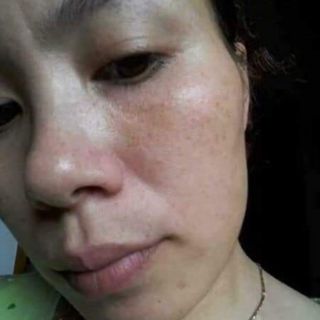 Bộ Kem Nám Vick White Beck ( trắng da mờ nám)