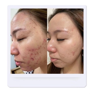 KEM PHỤC HỒI DA B5
