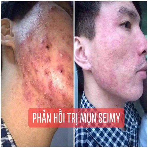 [CHÍNH HÃNG] Serum Giảm  Mụn - Thâm - Rỗ | Seimy Skin 7 Days (10ml) | Hiệu Qủa Sau 7 Ngày Sử Dụng | BigBuy360 - bigbuy360.vn
